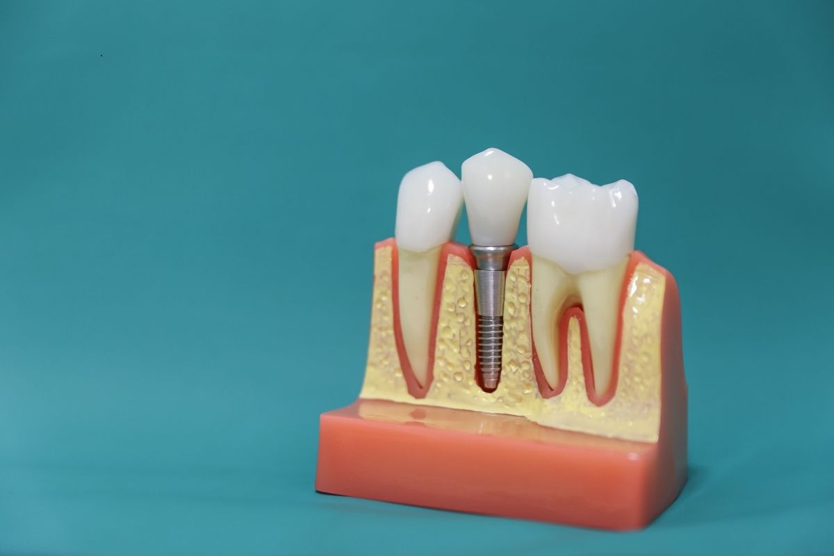 Dental Implants El Paso