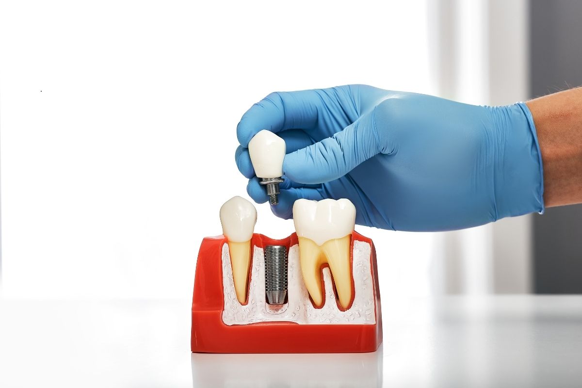 Dental Implants
